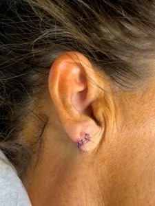 ear split surgery repair
ear lobe surgery after