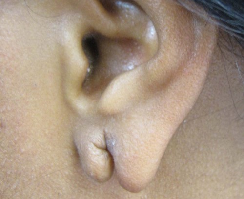 torn ear lobe surgery ripped ear lobe